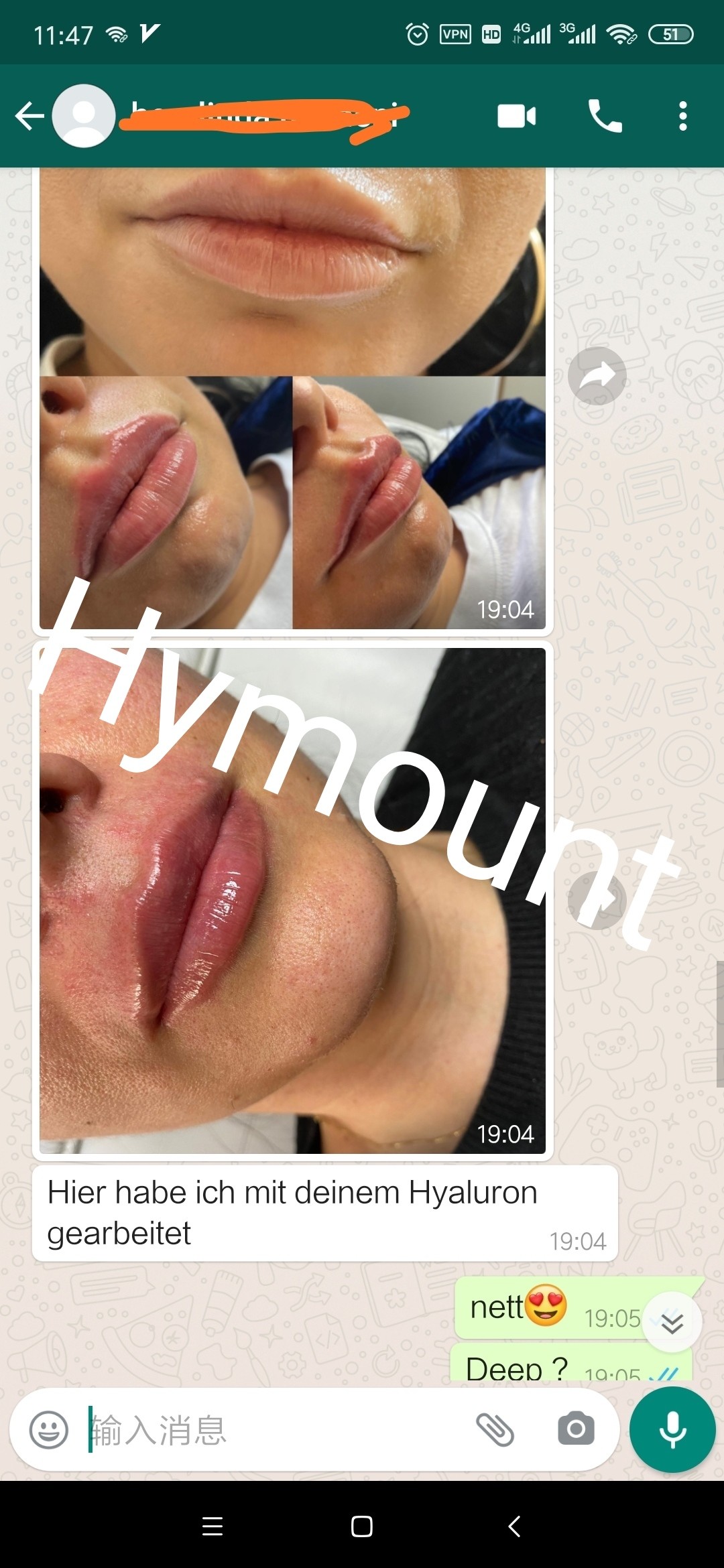 Latest company case about dermal filler feedback​ from our Switzerland customers